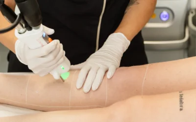 L’épilation laser : Tout ce que vous devez savoir avant de vous lancer
