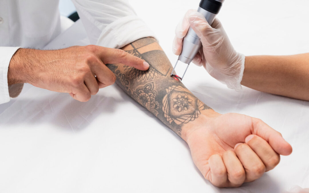 Laser tattoo removal: preconceived ideas and reality