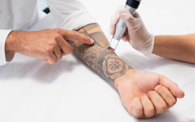 Détatouage laser : idées reçues et réalité