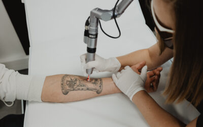 Détatouage laser : Le guide ultime de tout ce que vous devez savoir.