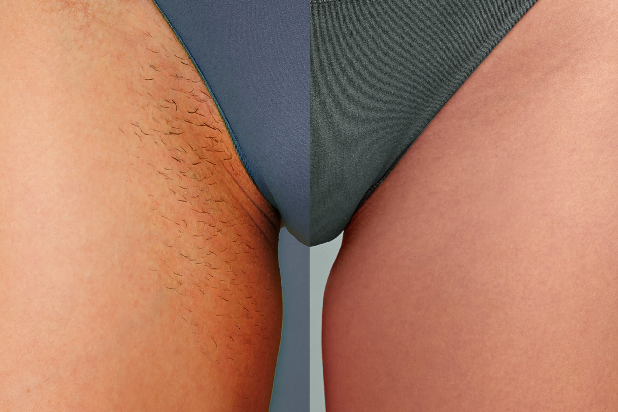 epilation laser du maillot