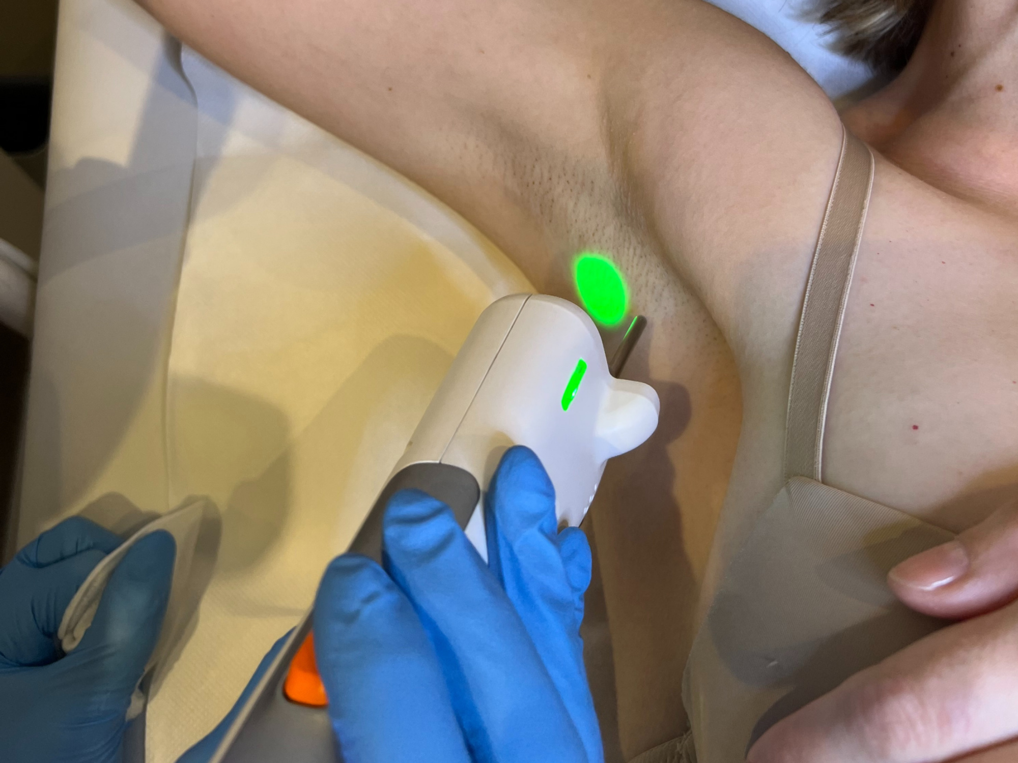 epilation laser aisselles