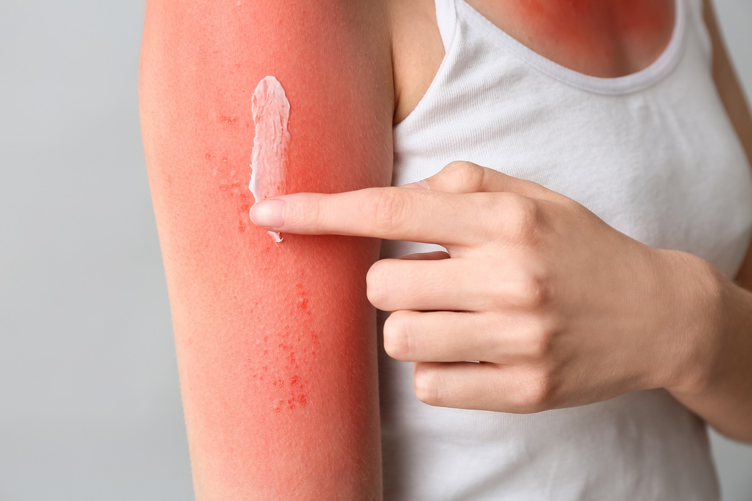 epilation laser brulures