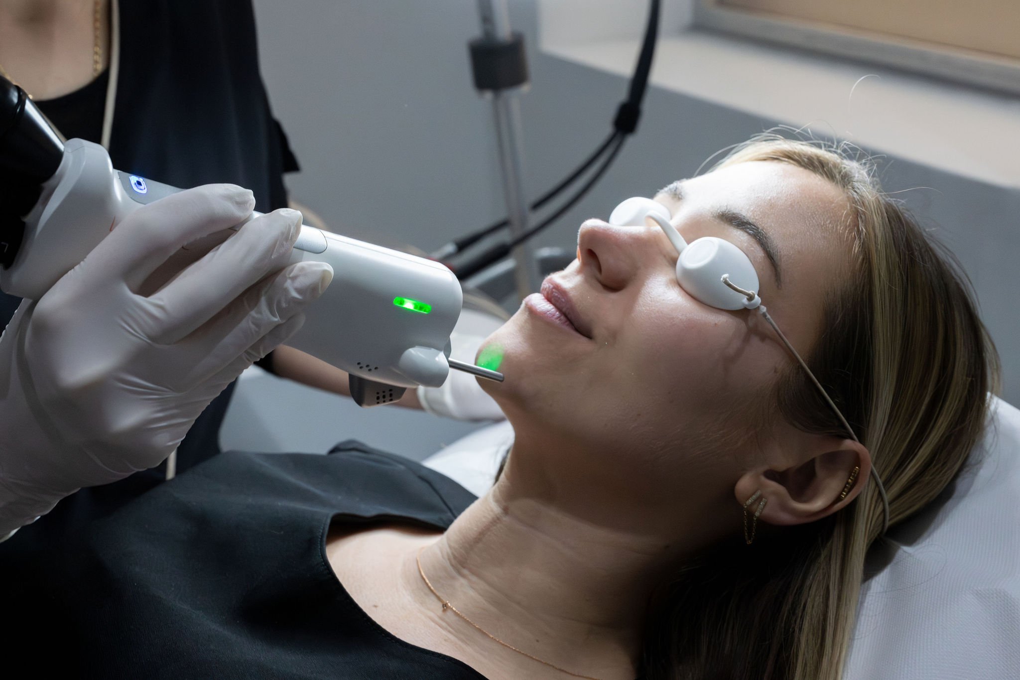 epilation laser menton