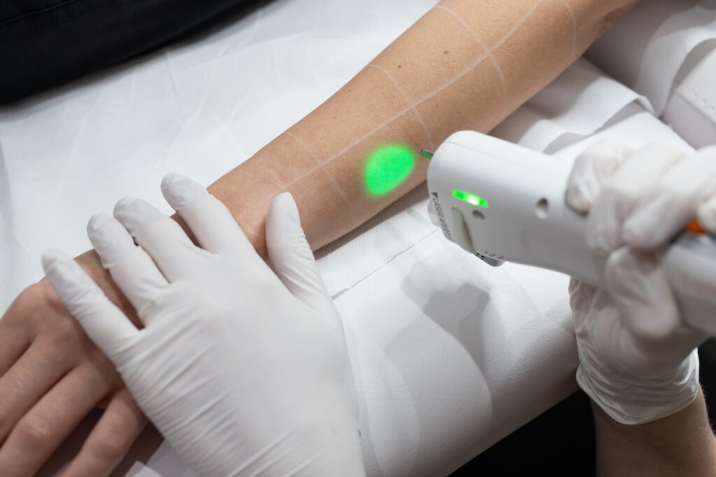 epilation laser des bras