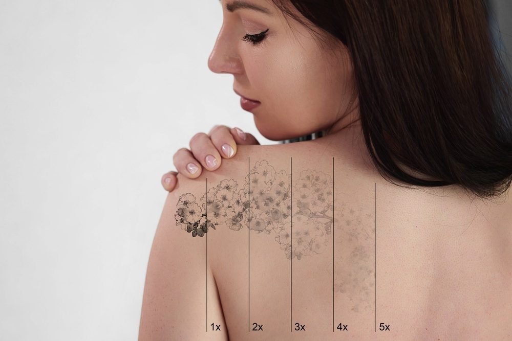 tatouage qui s'efface avec le detatouage laser