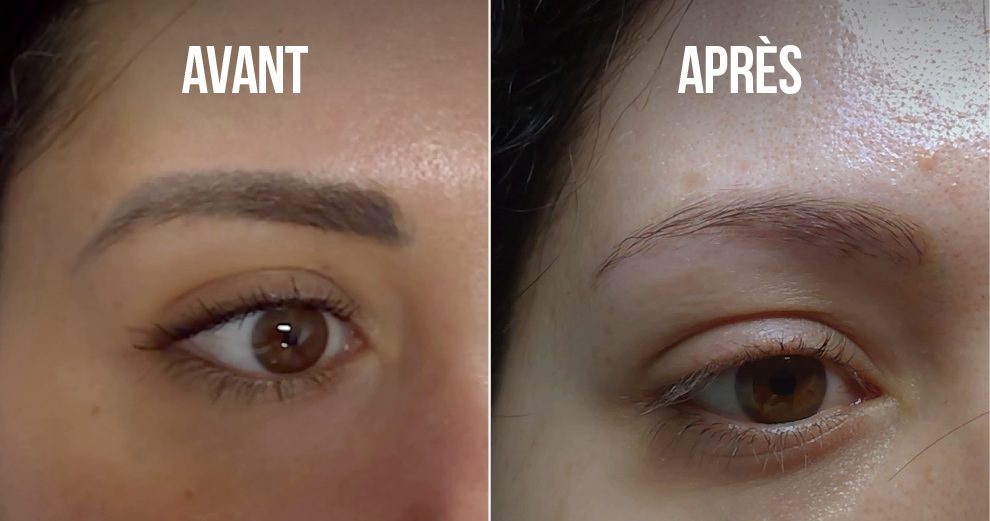 detatouage-sourcils